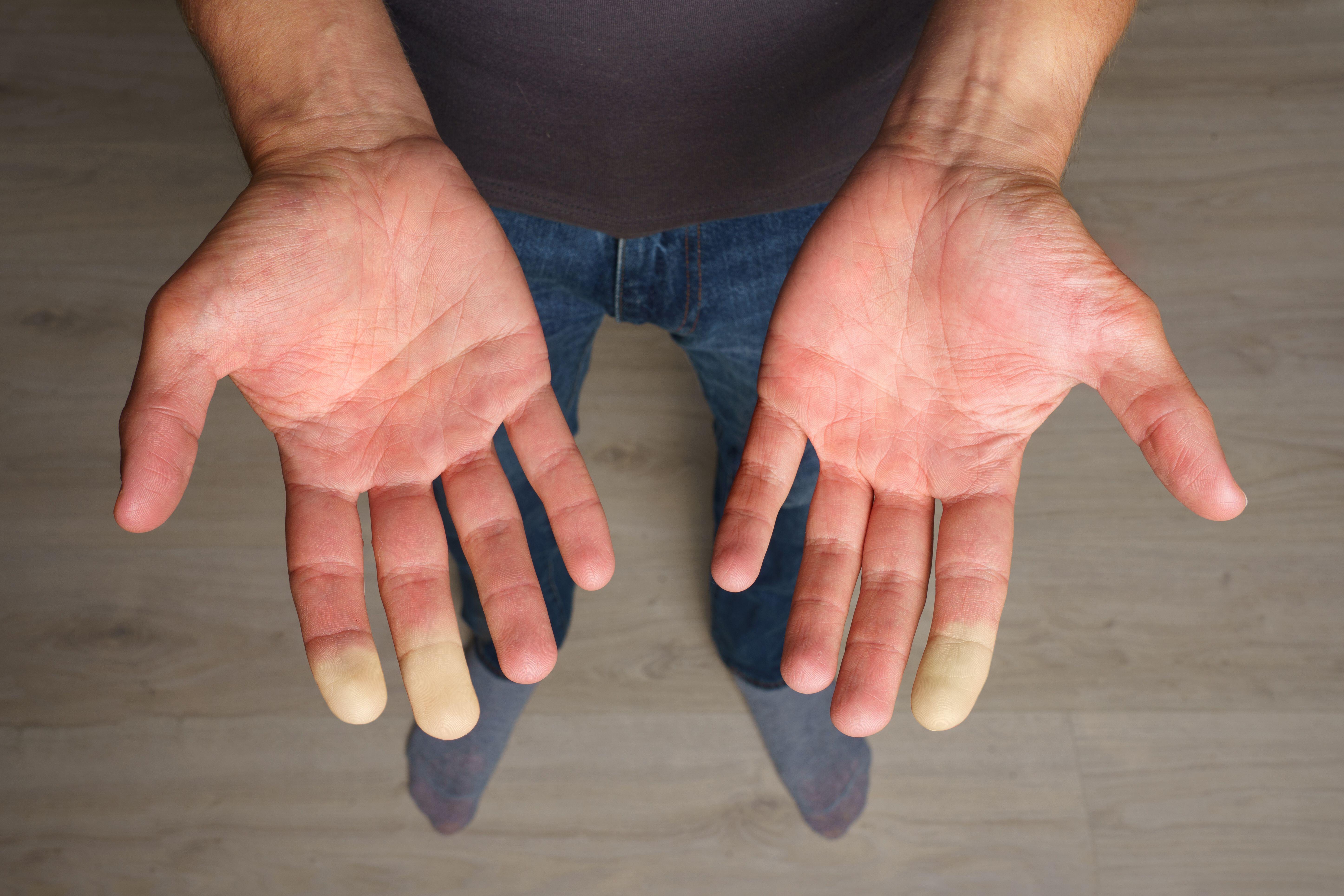 <p>Man with Raynaud’s showing his hands</p>