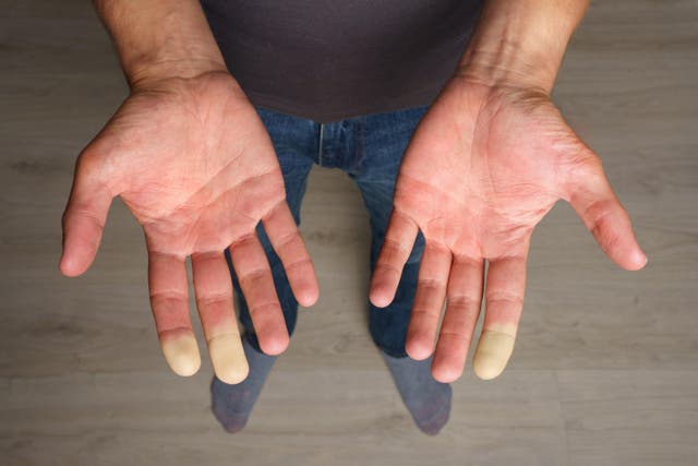 <p>Man with Raynaud’s showing his hands</p>
