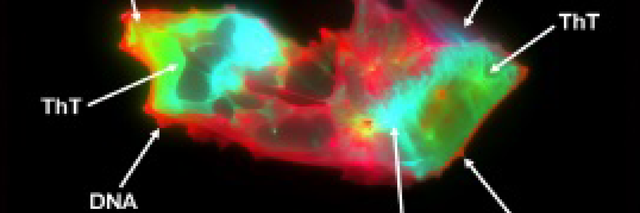 <p>Microscope image of a microclot found in the blood of a person with Long Covid</p>