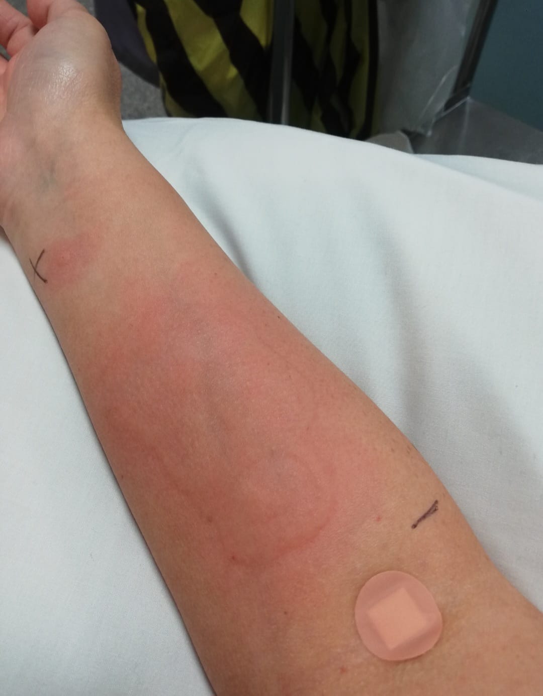 She underwent an ice cube test before receiving her diagnosis