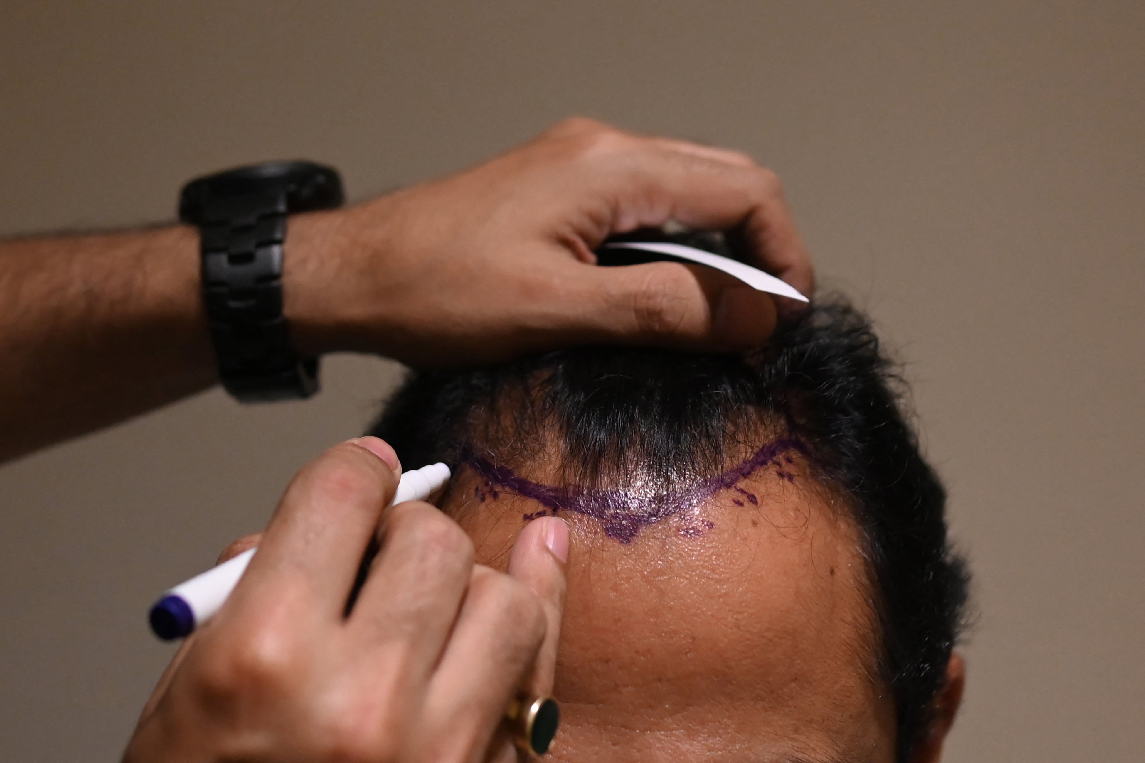 A doctor makes hairline markings on the scalp of a hair transplant patient