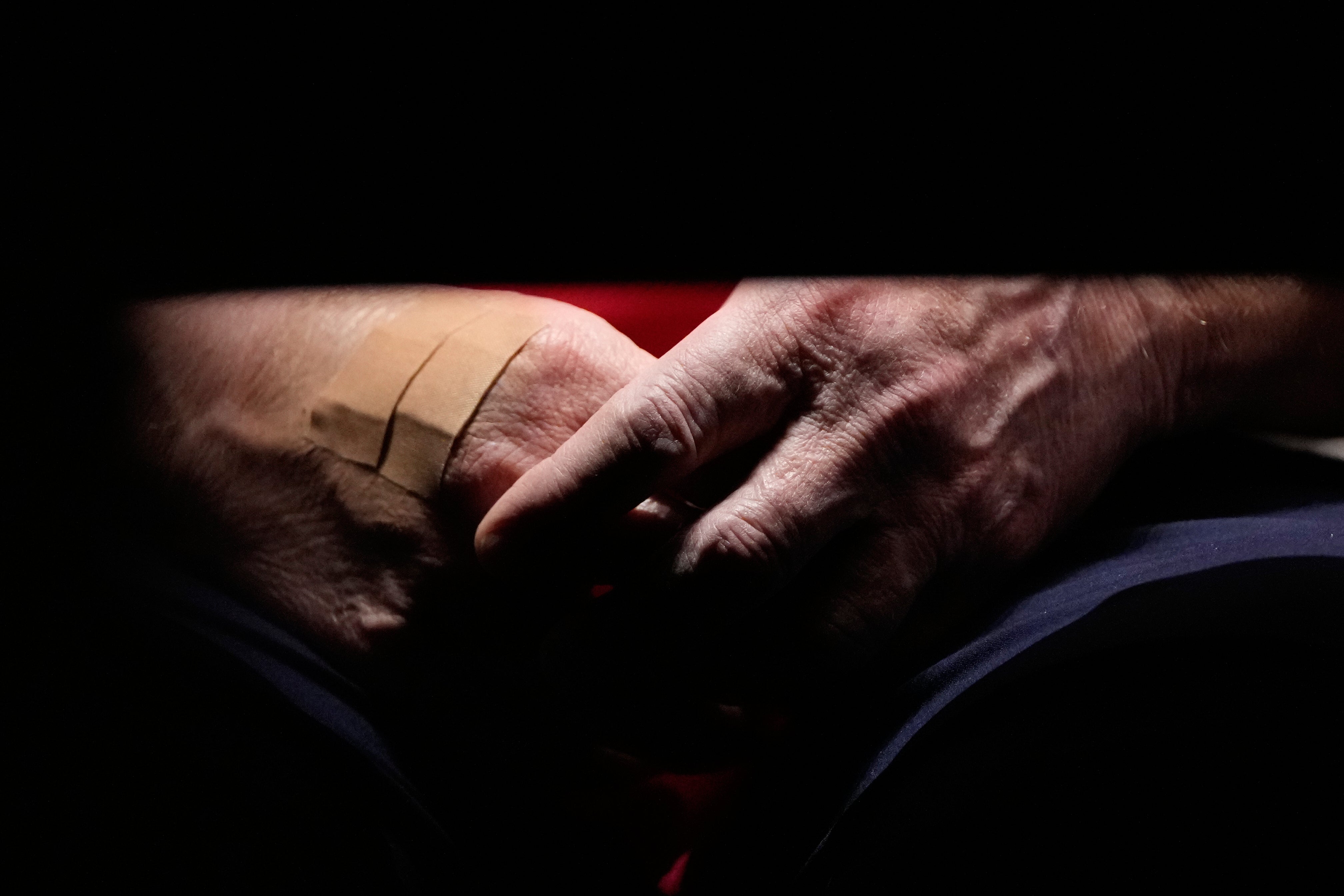 The president’s right hand is frequently bruised due to irritation from shaking hands and aspirin therapy