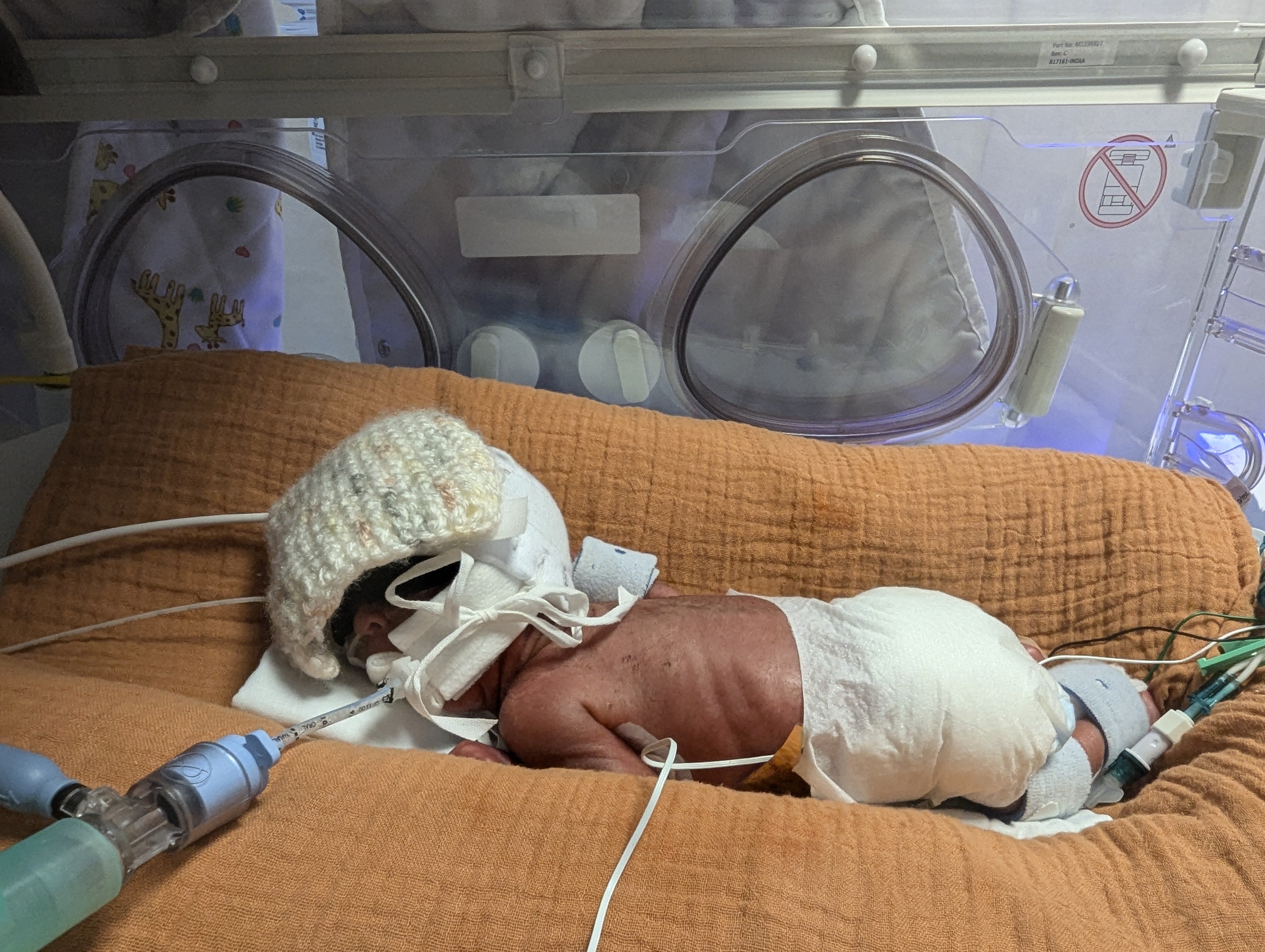 Anita Ibrahim-Goddard and Paul Goddard's son Adam in hospital after his premature birth. He weighed just 800g when he was born.