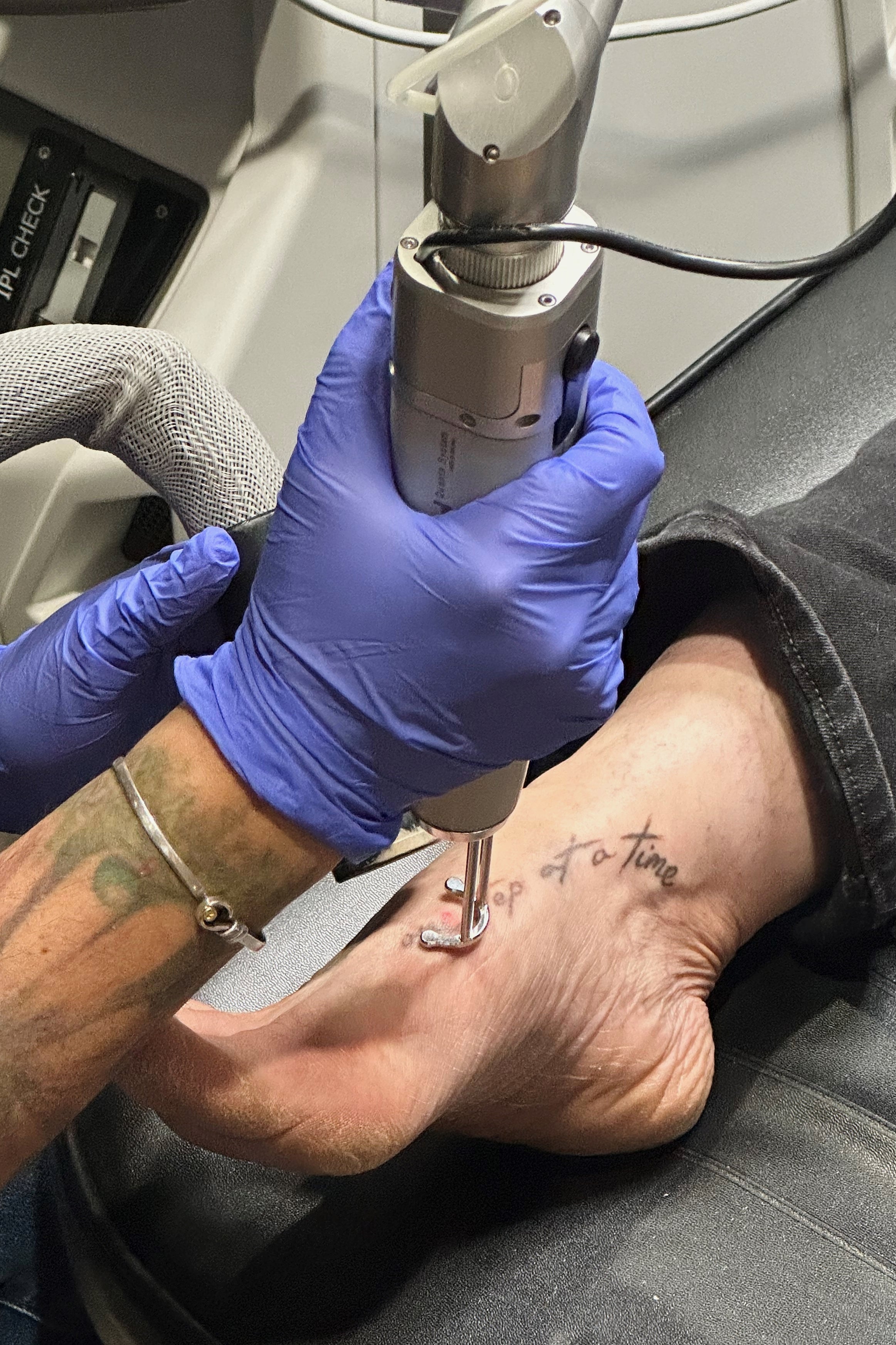 A more “civilized” tattoo removal method evolved in the 1960s when Leon Goldman, a University of Cincinnati dermatologist, used “hot vapor bursts” from a laser on tattoos