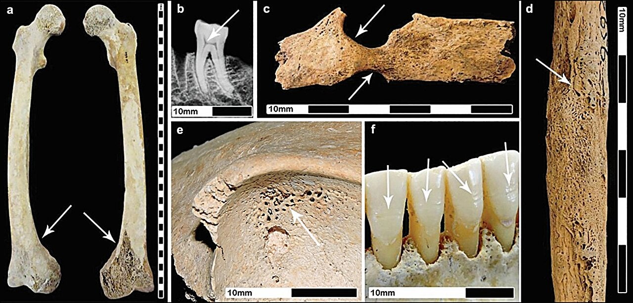 Indicators of stress on some of the Roman Period adult female skeletons