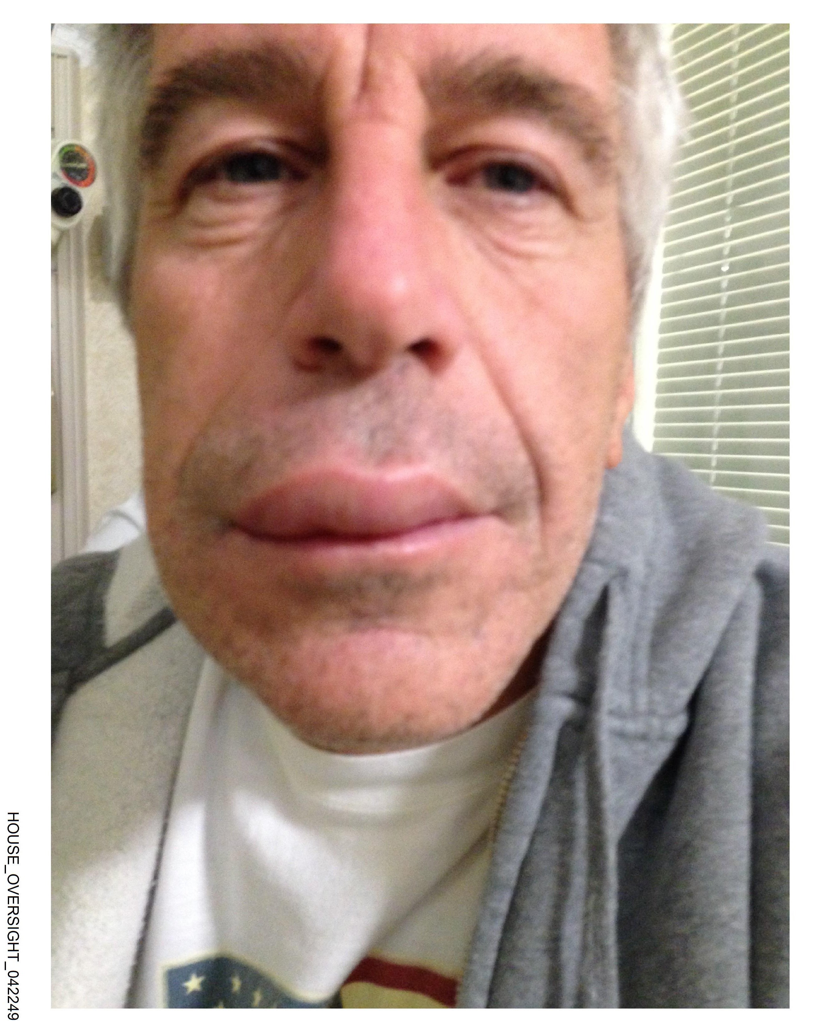 <p>Jeffrey Epstein is seen with a swollen lip in a photo from his estate </p>