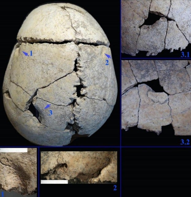 Archaeologists analysed several holes in the teenager's brain