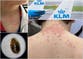 ‘Unrelenting itchy feeling’: Family ambushed by bed bugs aboard transatlantic flight sues over ruined trip