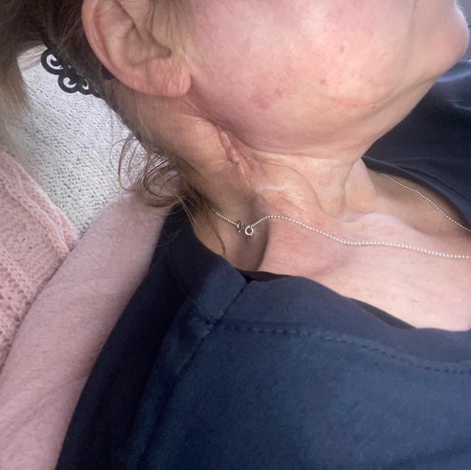 Clare had an operation to remove the affected lymph nodes