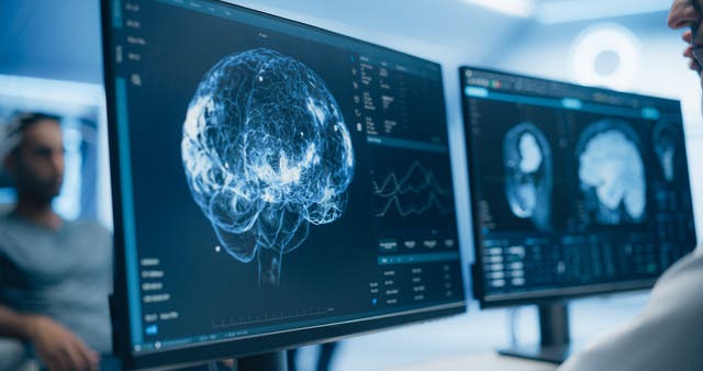 The speed of childhood brain development can predict the emergence of mental health issues, the analysis of almost 30,000 brains over six years has revealed