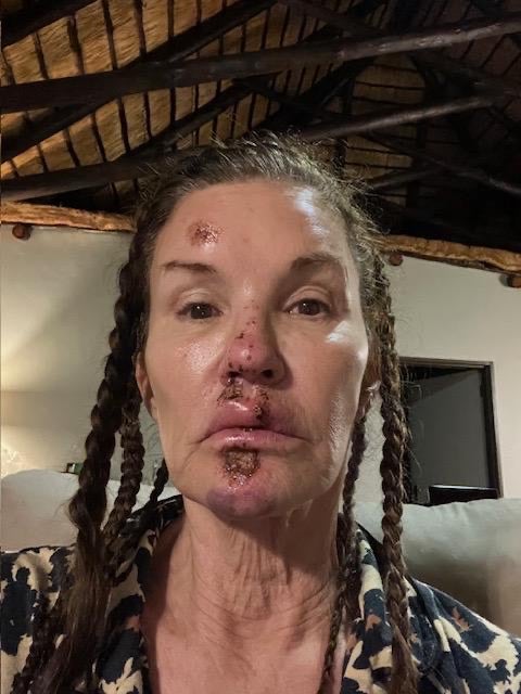 Supermodel sues I&rsquo;m A Celebrity producers over alleged facial injuries