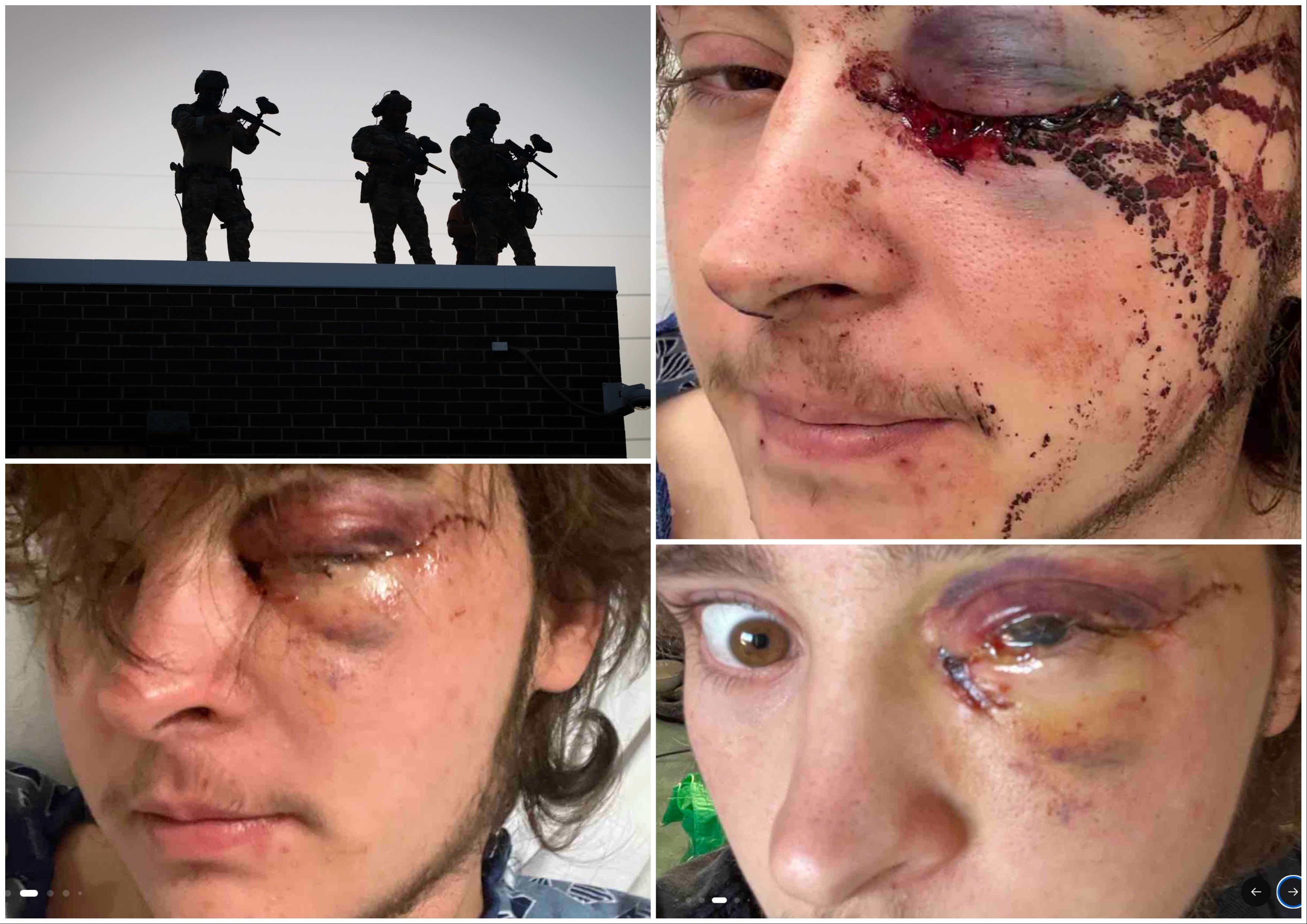 <p>Kaden Rummler, 21, will never again see out of his left eye after being struck by a pepper ball round fired by a federal agent at an anti-ICE protest</p>