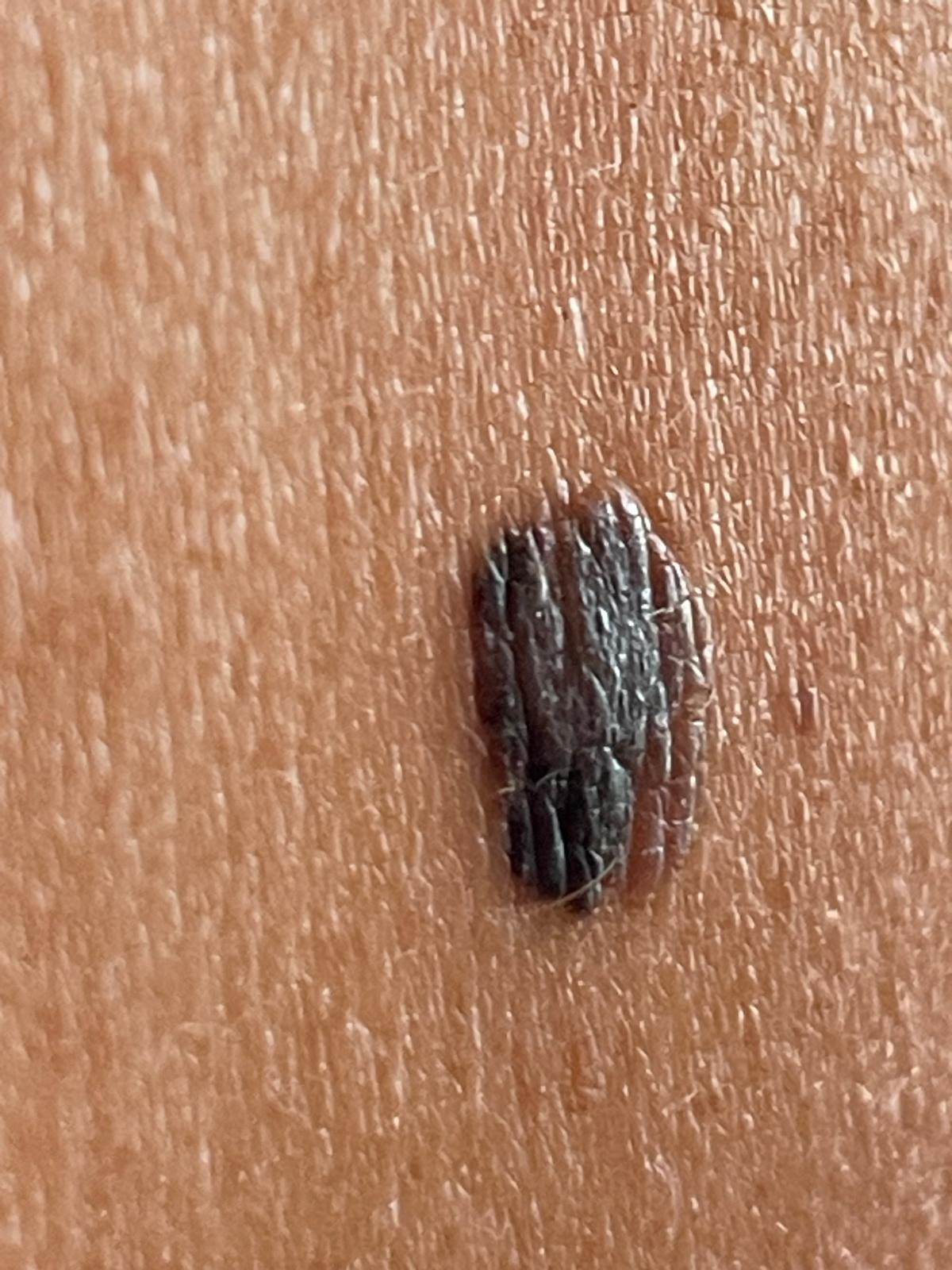 Emma Wigmore, 50, from London was enjoying a hot summer’s day on the Southbank with her friends in June 2025, when she had a chance encounter with an off-duty dermatologist who happened to notice a “worrying” mole on her back.