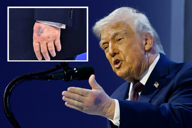 <p>President Donald Trump has been pictured with a large bruise on his left hand while delivering a speech about his ‘Gaza board of peace’ in Davos, Switzerland</p>