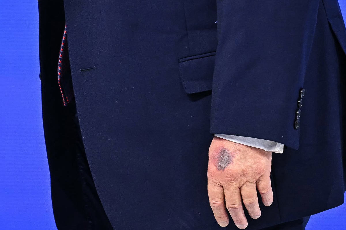 The reason Trump’s hand was covered in big bruise at Davos