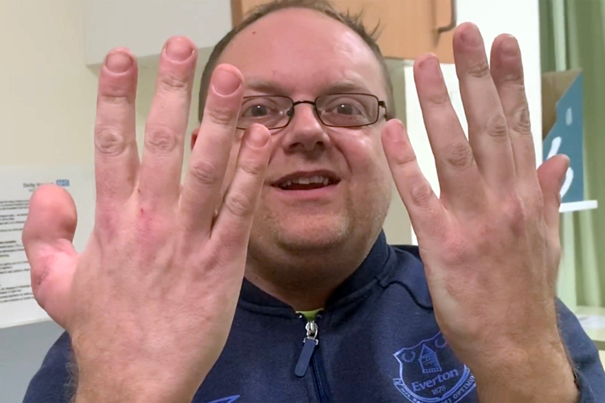 ‘I need bigger gloves because my thumb is a big toe’