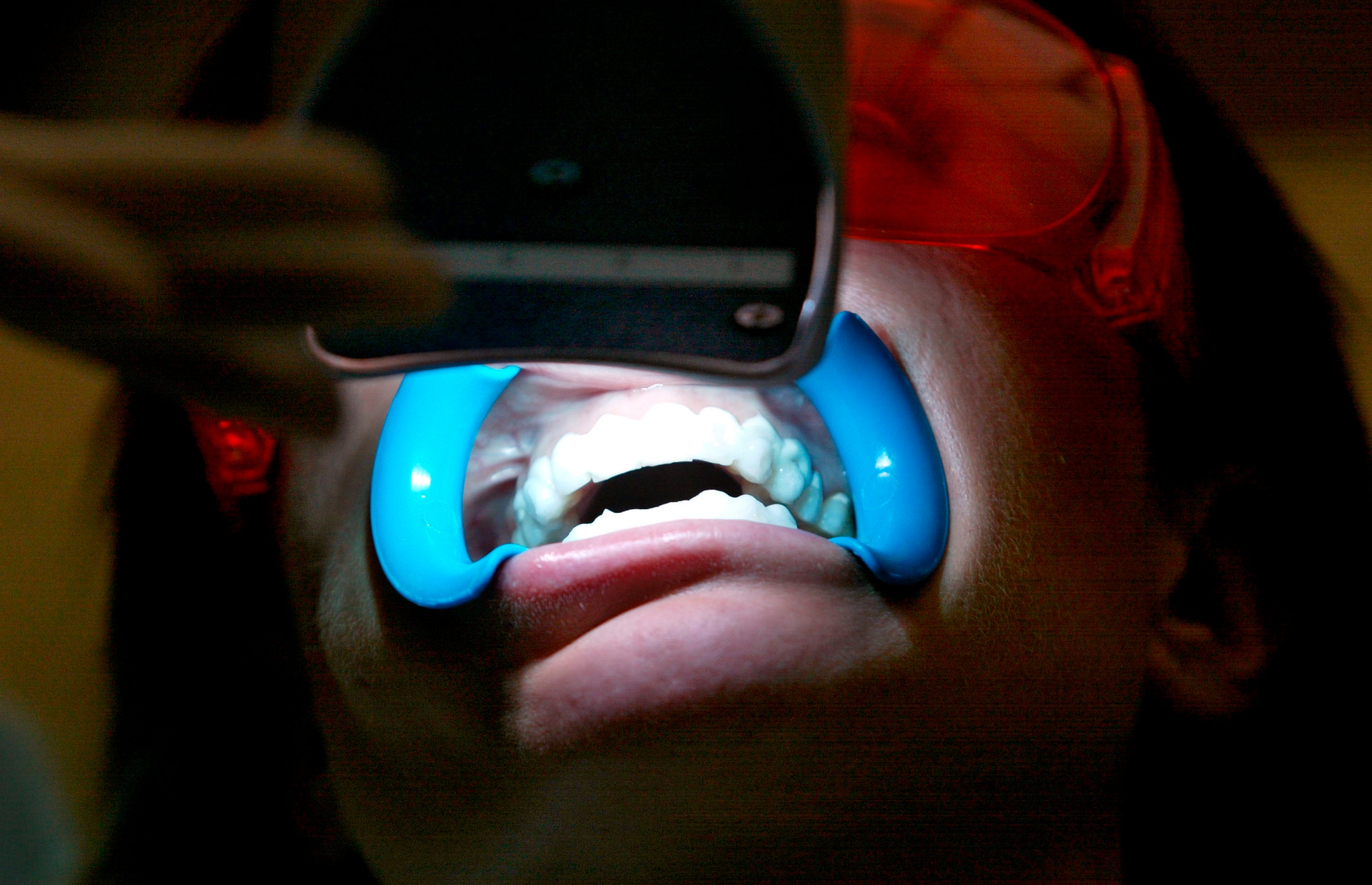 <p>Woman has teeth whitened with ultraviolet light</p>