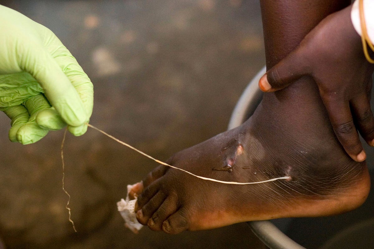 World creeps closer to eradicating human Guinea worm cases, with just 10 last year: Carter Center