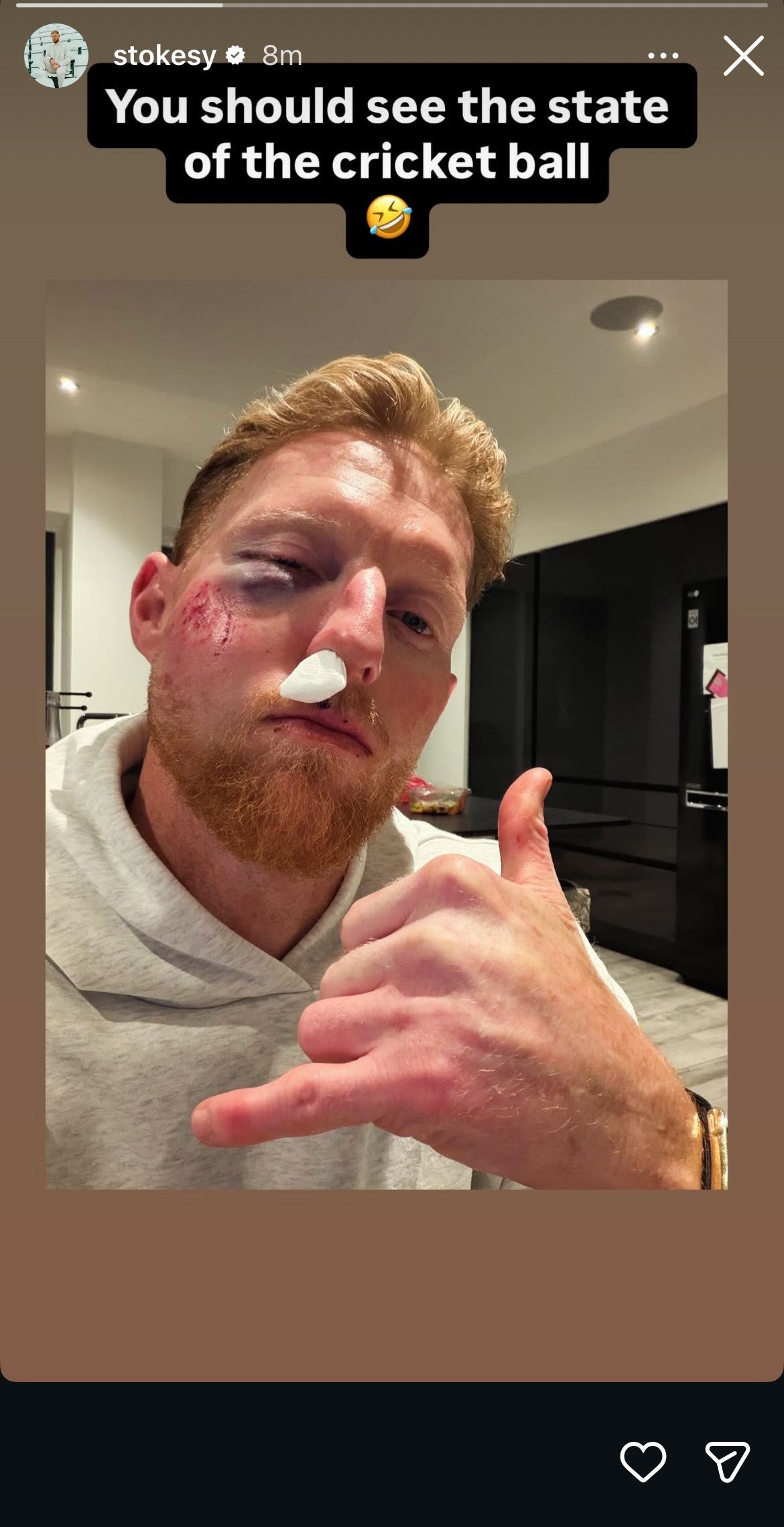 Бен Стокес је задобио значајну повреду лица (Бен Стокес/Инстаграм)