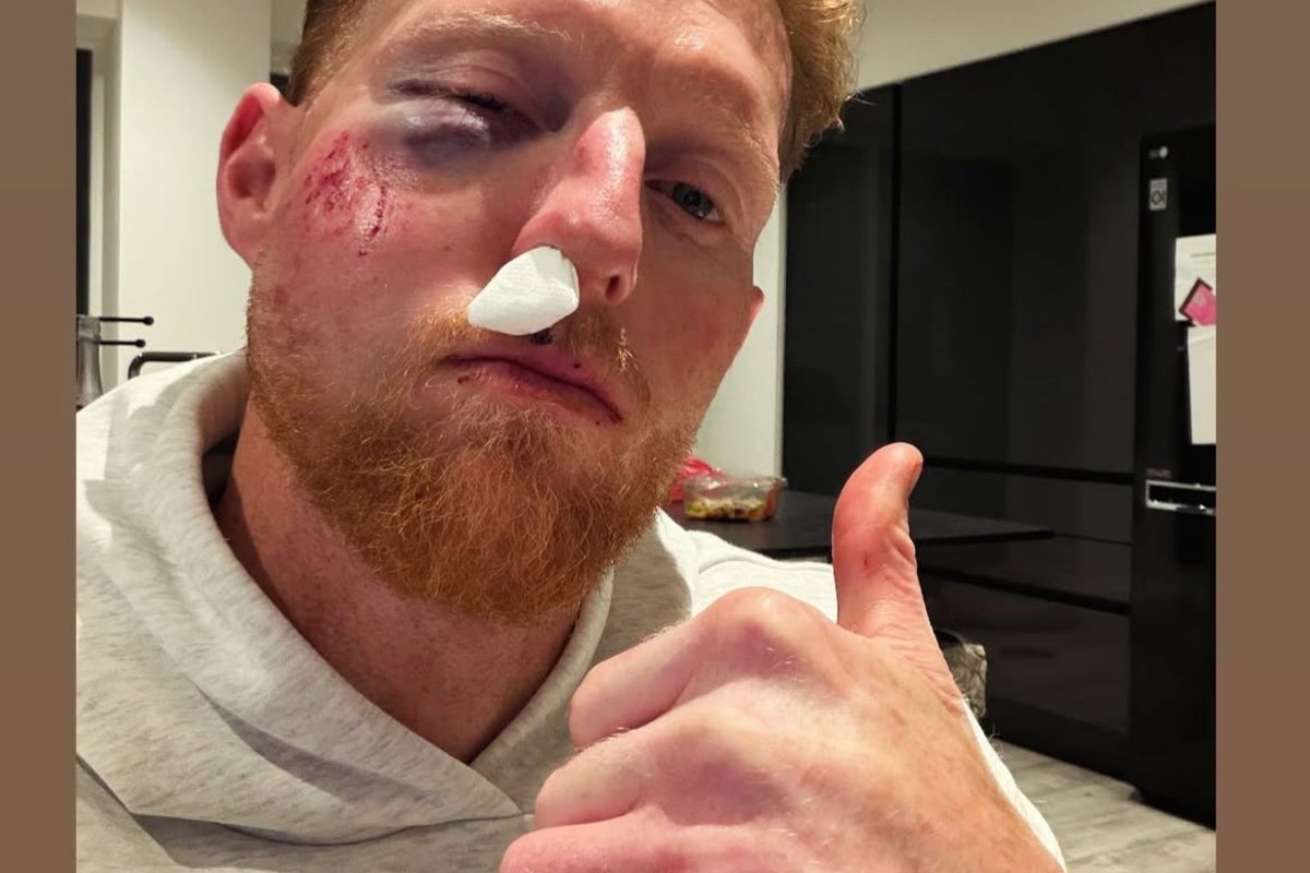 Ben Stokes suffers gruesome facial injury after being struck by a ball Ben Stokes suffers gruesome facial injury after being struck by a ball