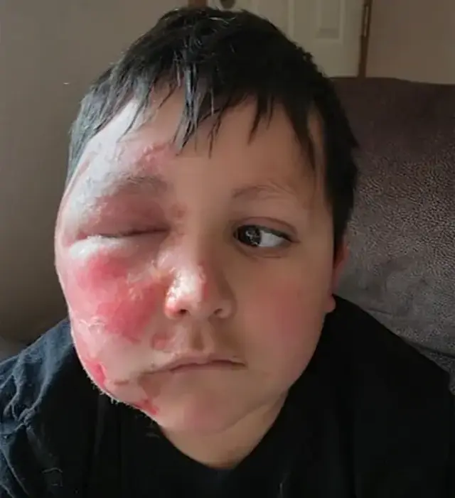 <p>An Illinois boy received second-degree burns to his face after a TikTok trend caused his toy to explode on him </p>