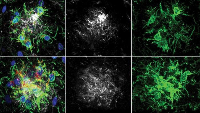 Researchers say when the PTP1B protein was deleted in a mouse’s brain, as shown in the bottom row, the brain’s immune cells (green) were better at engulfing harmful amyloid beta plaques (grey), as shown in the left column