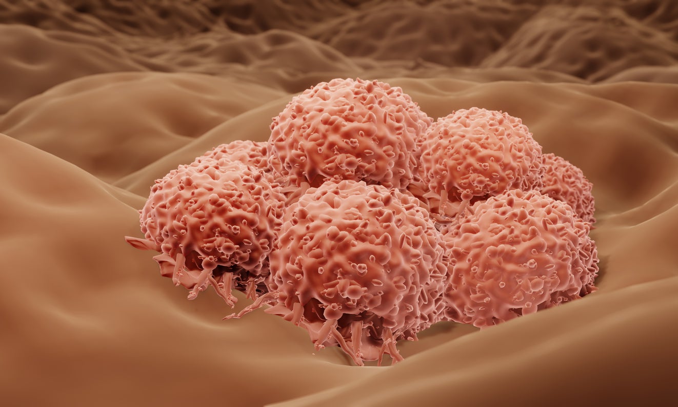 An illustration shows melanoma cells in the human body. Melanoma deaths make up the majority of America’s yearly skin cancer deaths