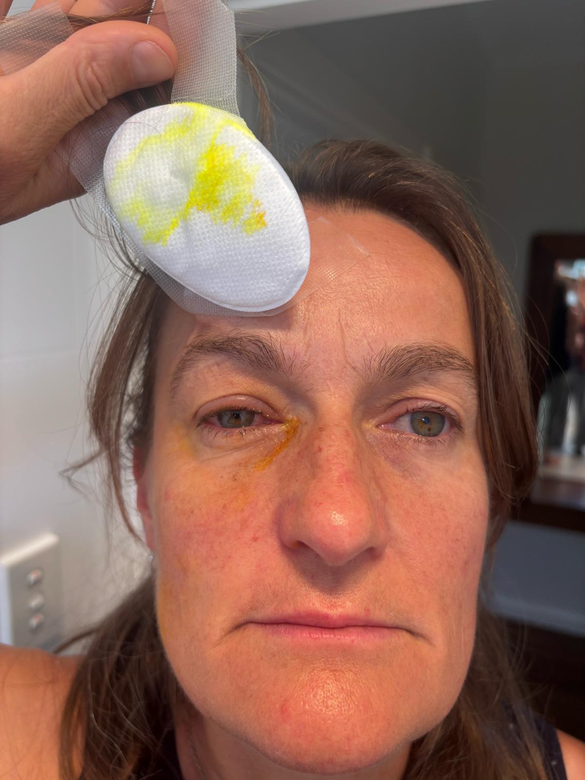 Rebecca Payne says her eyes burned after Australian police pepper-sprayed a crowd protesting the visit of Israeli president Isaac Herzog in Sydney