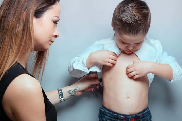 Measles