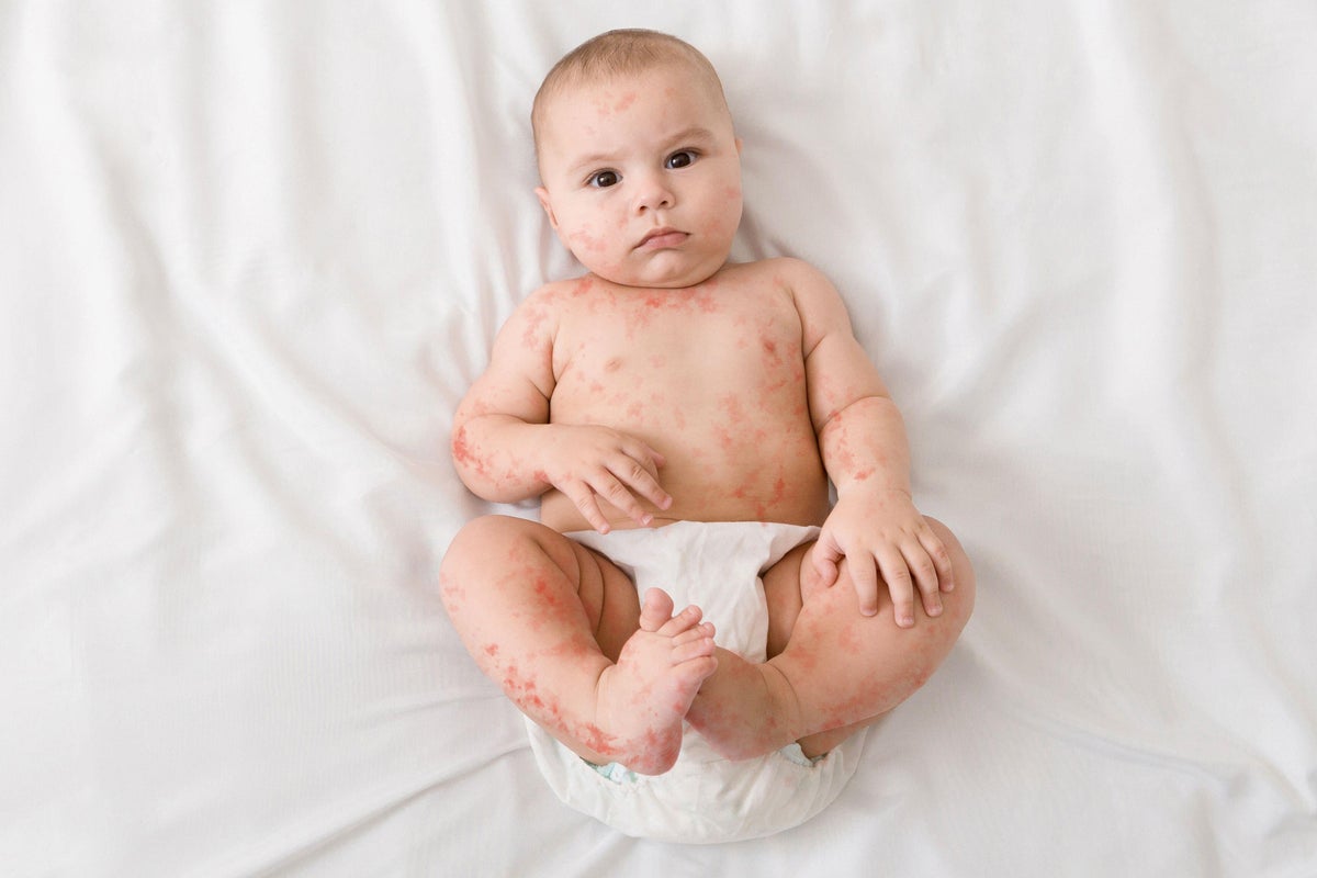 What is measles? The six subtle symptoms to look out for in children 
