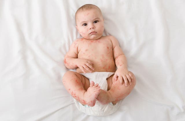 <p>Upset newborn baby suffering from measles rash (Alamy/PA)</p>