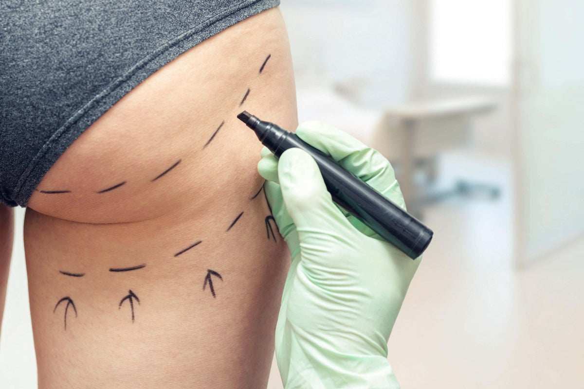 Delaying Brazilian Butt Lift ban poses ‘serious threat to patient safety’ MPs warn