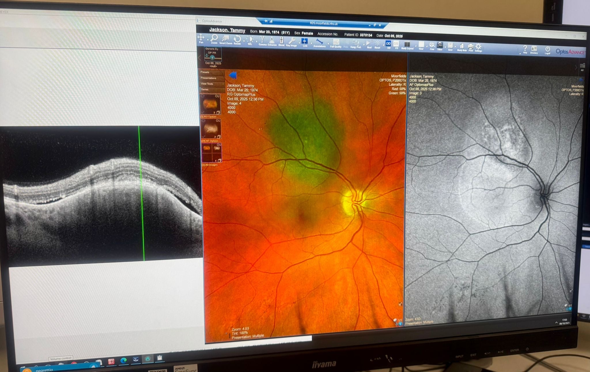 Tammy’s Moorfields Eye Hospital scans