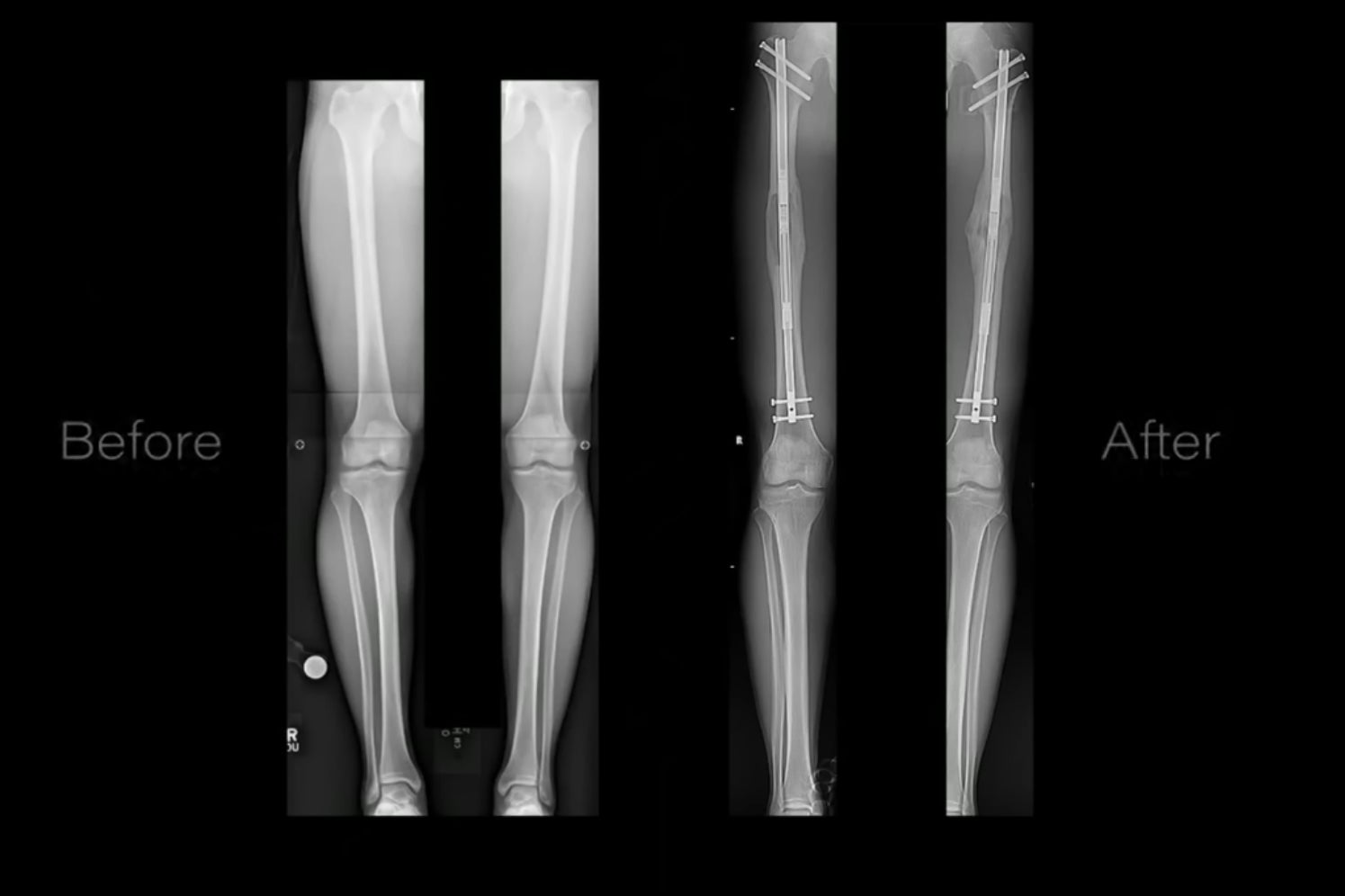 <p>‘Periodically I am asked what I think about leg-lengthening surgery’</p>