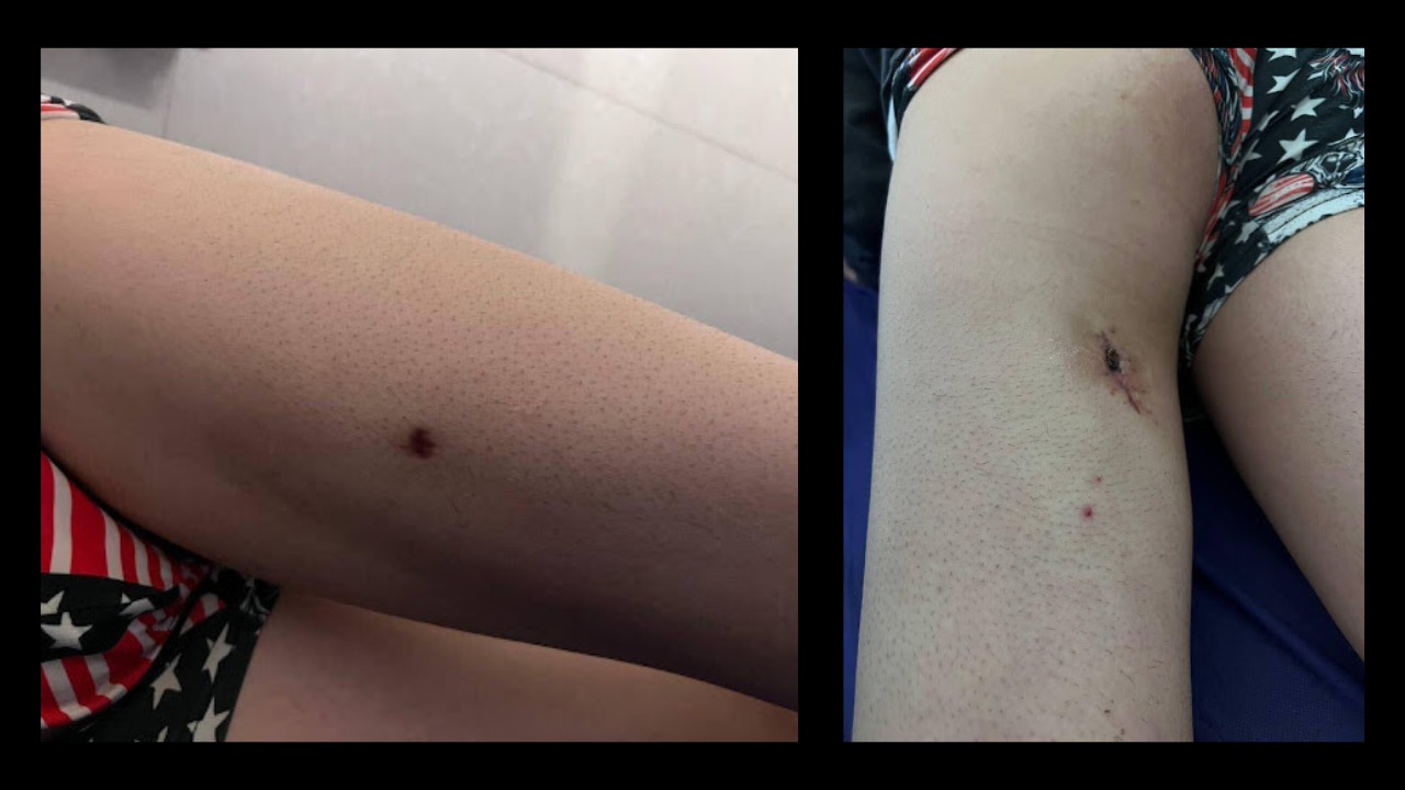 A bullet has entered through the front of the thigh and exited through the back, known as a through-and-through wound.