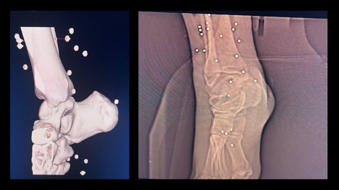 Shotgun pellets in the foot area of a patient seen in CT scan and X-ray images.