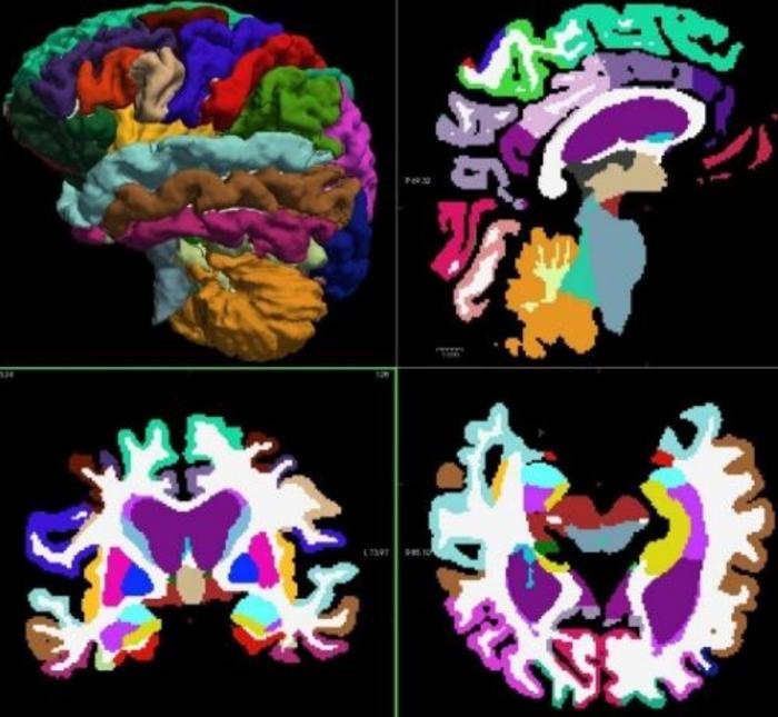 Segmented MRI images show the regions of a normal brain