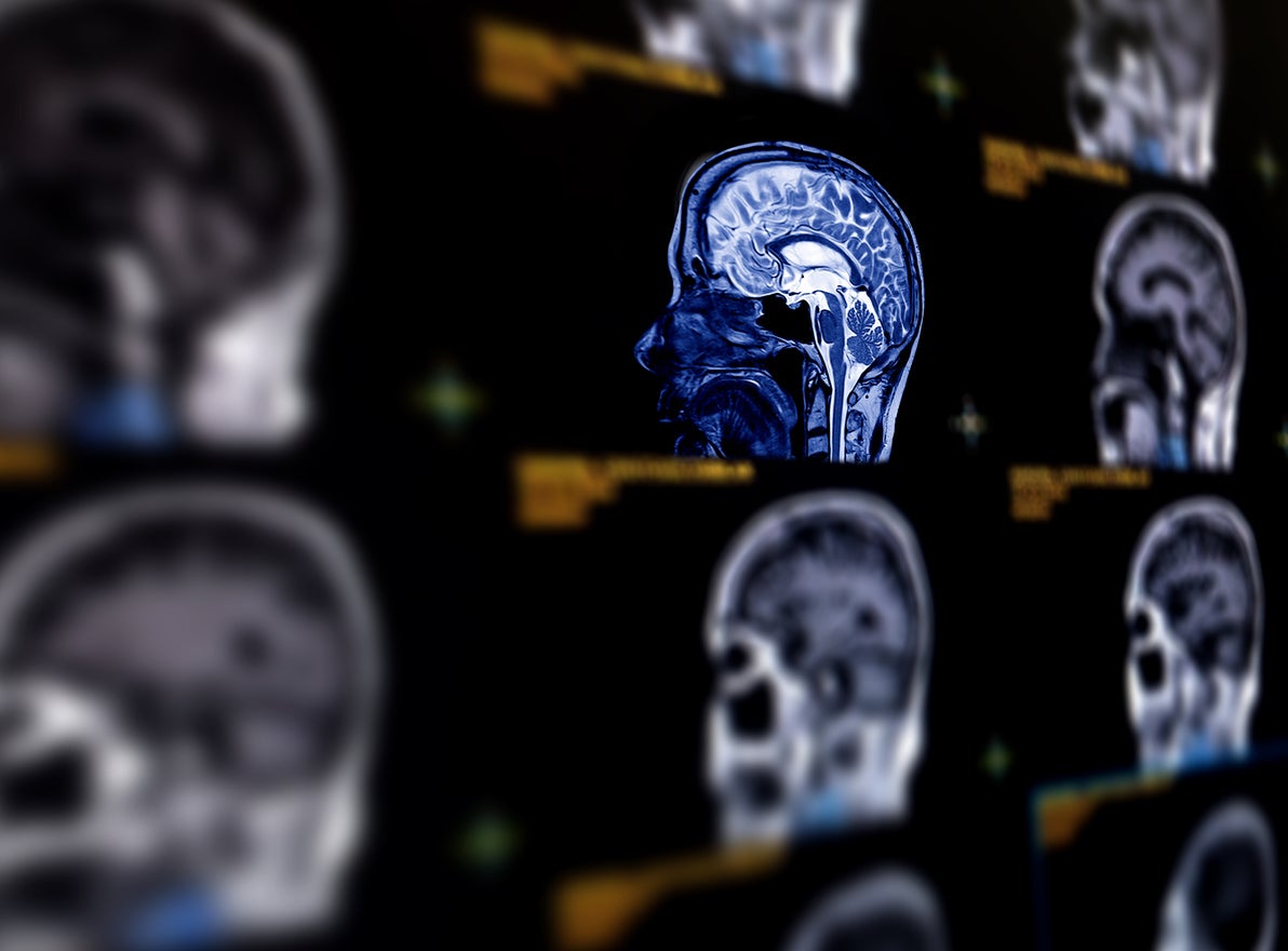 independent.co.uk - Julia Musto - Researchers say AI can predict Alzheimer's disease with close to 93 percent accuracy