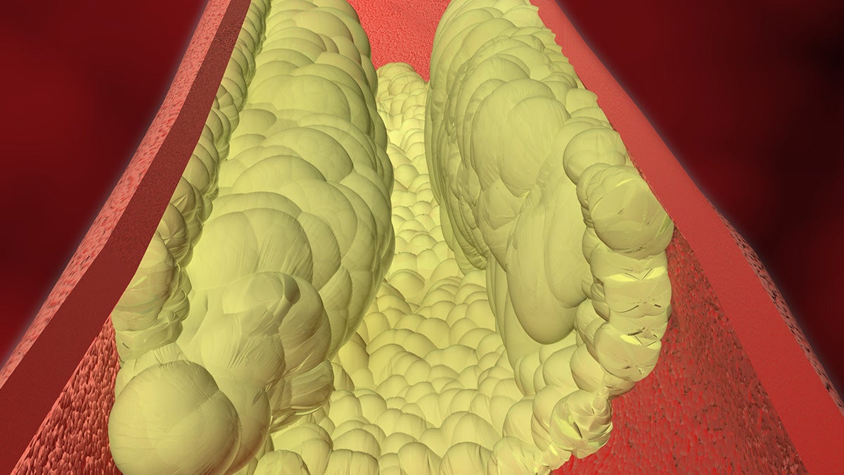 Plaque caused by high levels of the waxy substance known as cholesterol is seen filling and narrowing an artery in this graphic image from the U.S. Centers for Disease Control and Prevention. Blockages from this plaque can lead to a higher risk of heart attacks and stroke