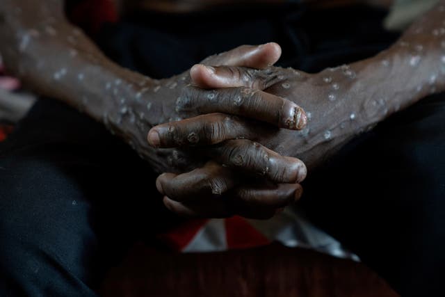 CONGO MPOX
