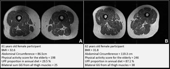 Thigh MRI scans of a 61-year-old woman, A, and a 62-year-old woman, B, show the impact of ultraprocessed foods. The 62-year-old’s diet was 87 percent ultraprocessed and the 61-year-old’s was just under 30 percent