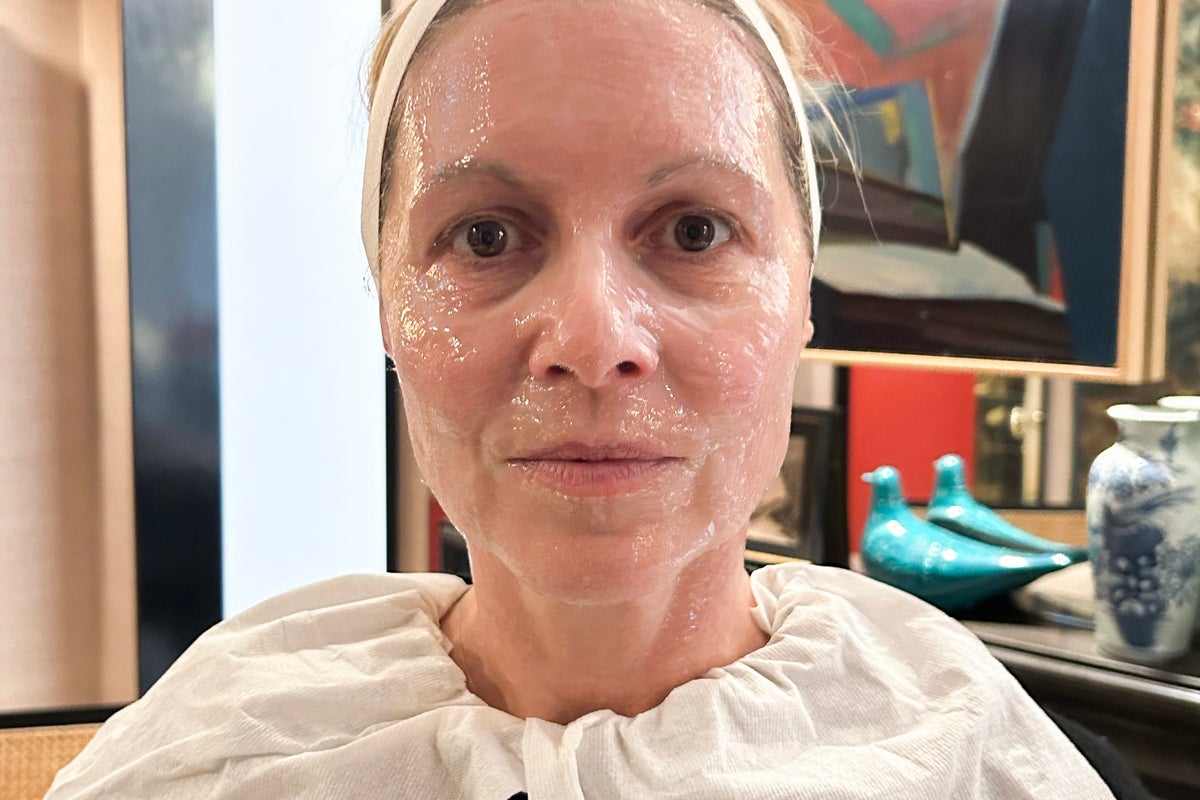 I had a non-surgical facelift – the results really surprised me – UK Times I had a non-surgical facelift – the results really surprised me – UK Times