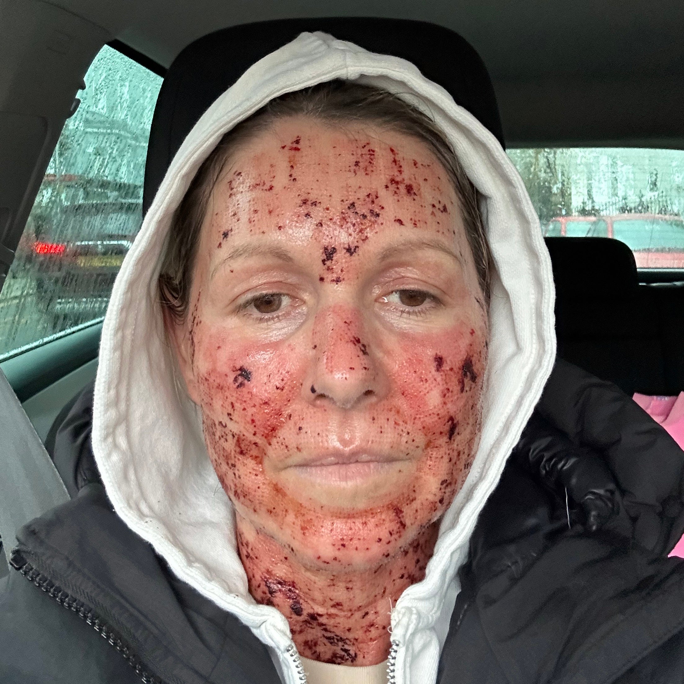 How I looked at school pick up straight after the proceedure, but it was only dried blood