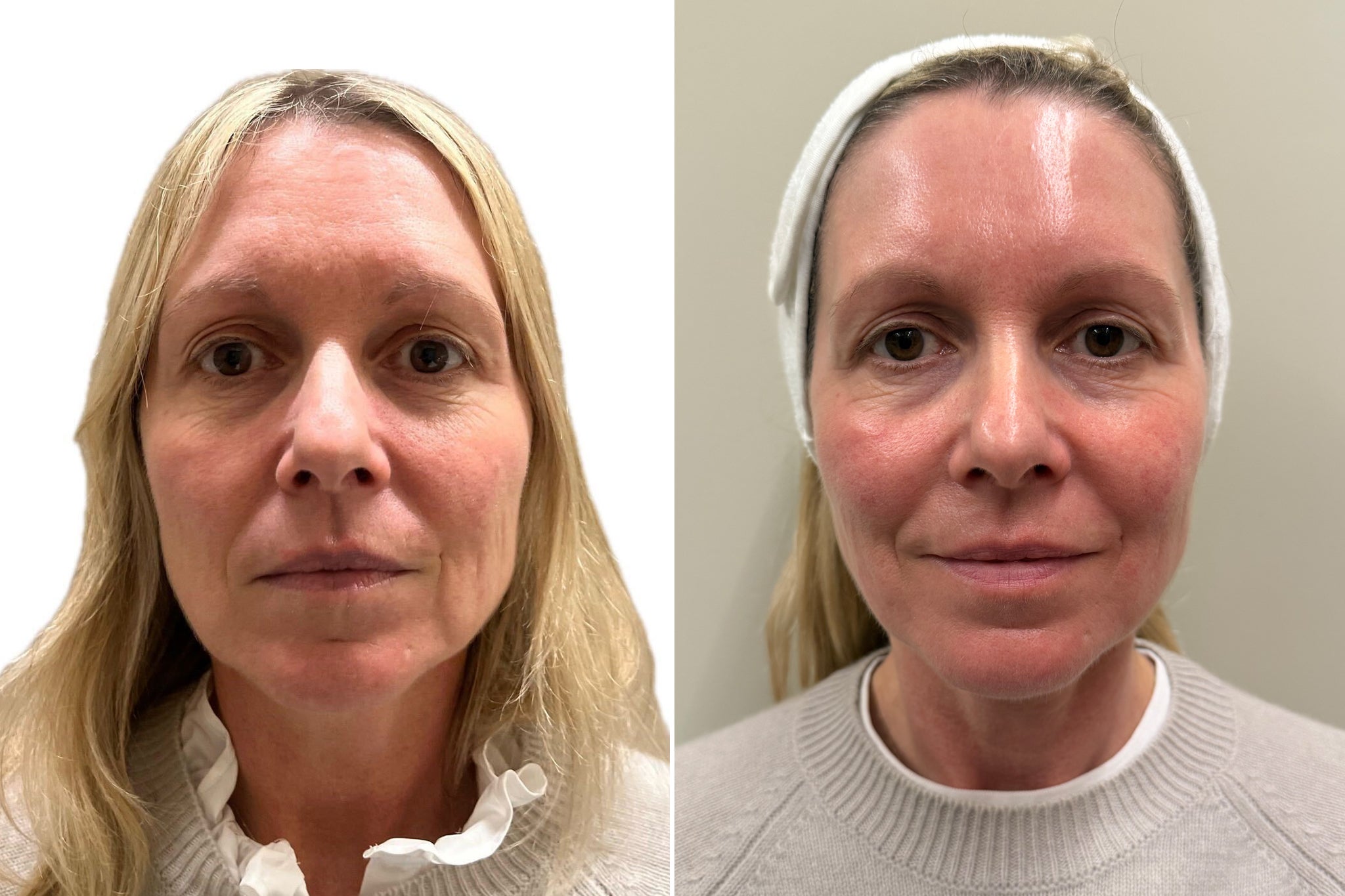 Before and after: Prior to the treatment in February – and then two months later