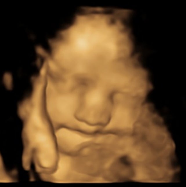 The facial reactions of the foetus whose mother took kale capsules during pregnancy as part of a controlled experiment, scanned using ultrasound at weeks 32 gestation