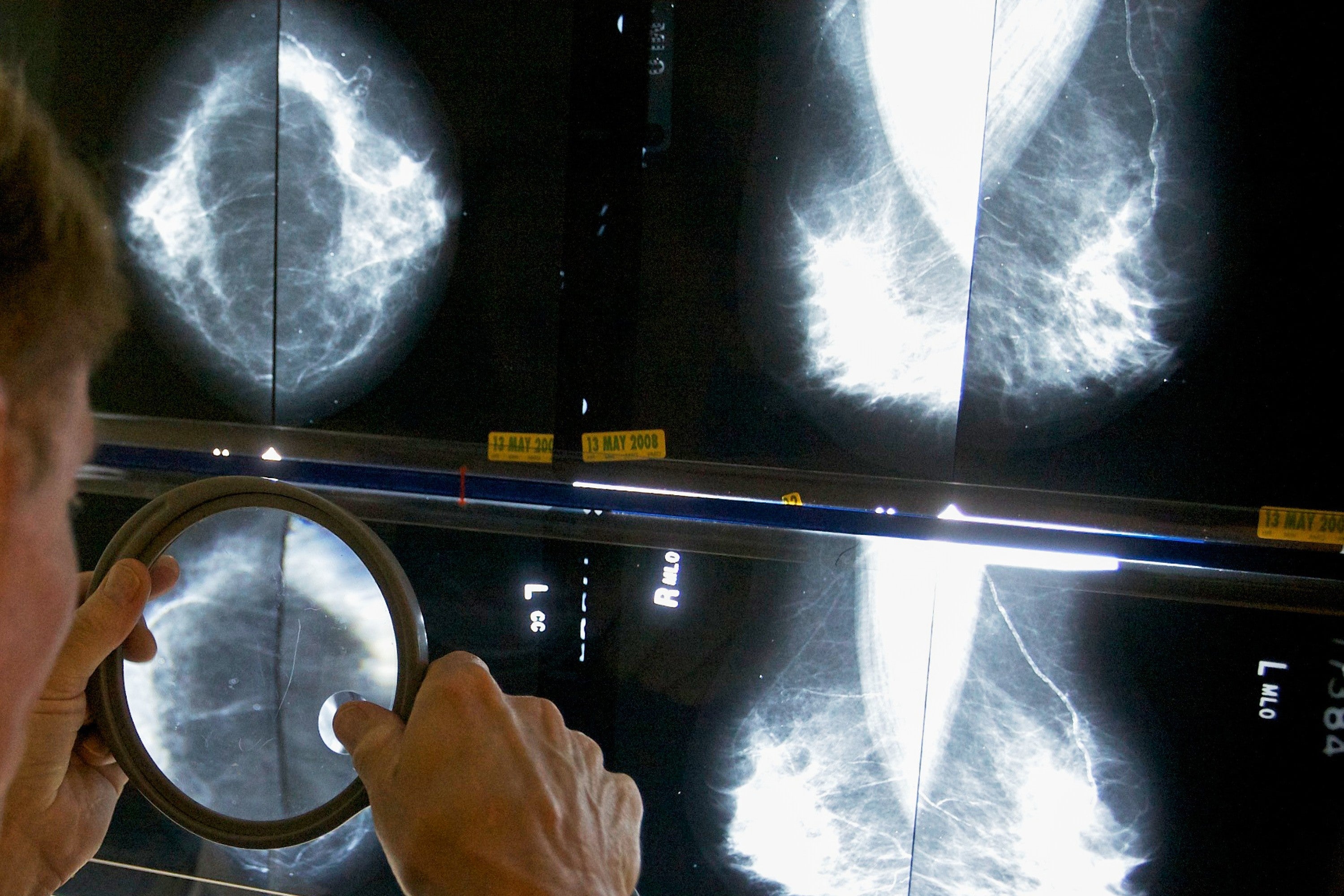 A radiologist uses a magnifying glass to examine mammograms for breast cancer in Los Angeles