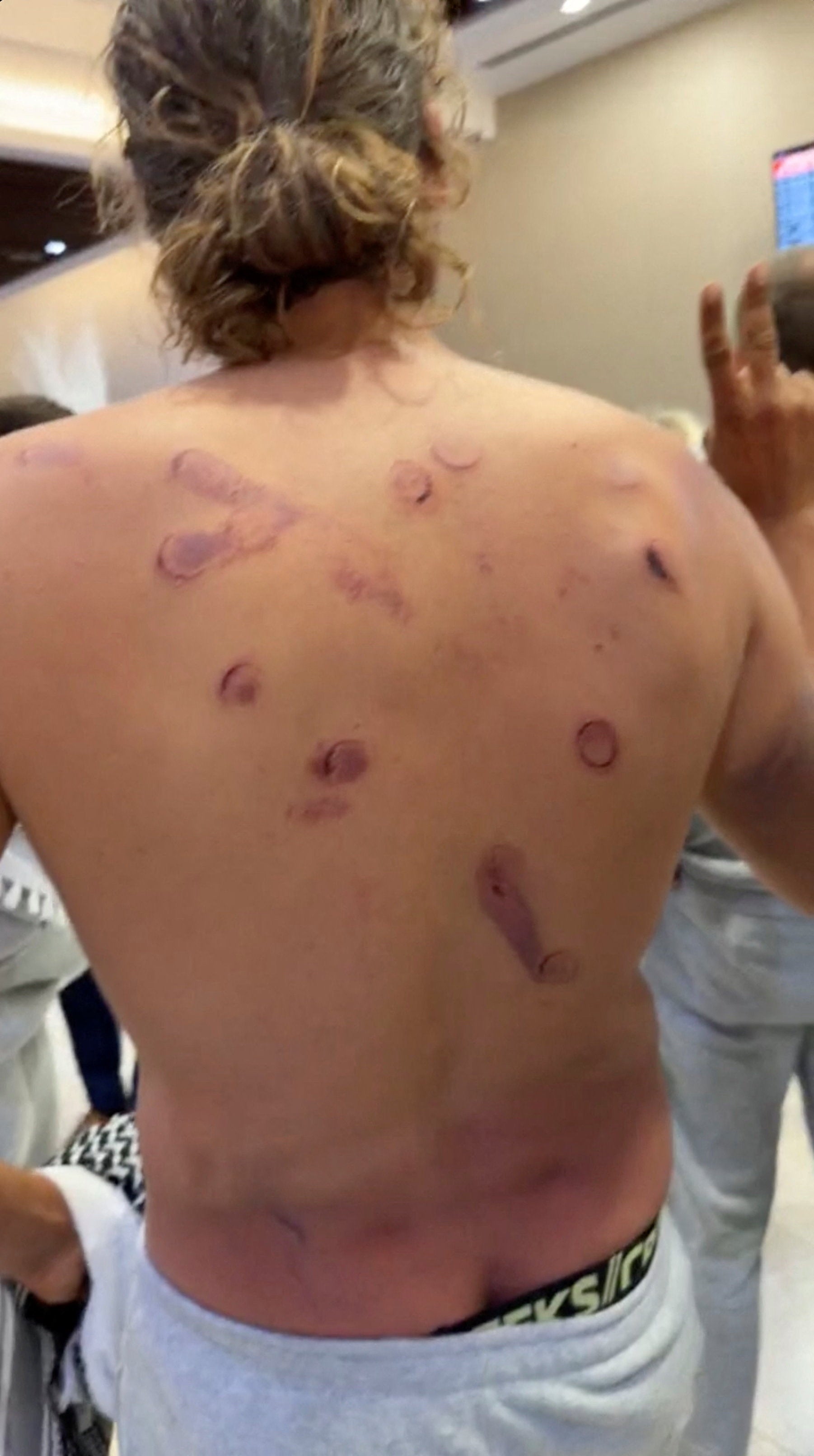 French national Adrien Jouan shows injuries to his back