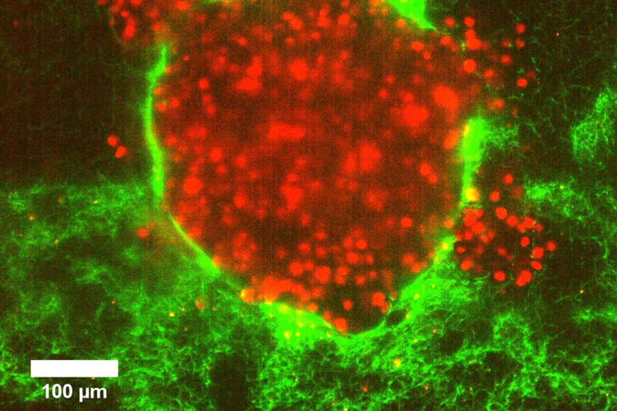 Studies reveal why some cancers are so much more dangerous than others – UK Times Studies reveal why some cancers are so much more dangerous than others – UK Times