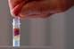 How a simple blood test could spot signs of Alzheimer’s ‘decades before symptoms’