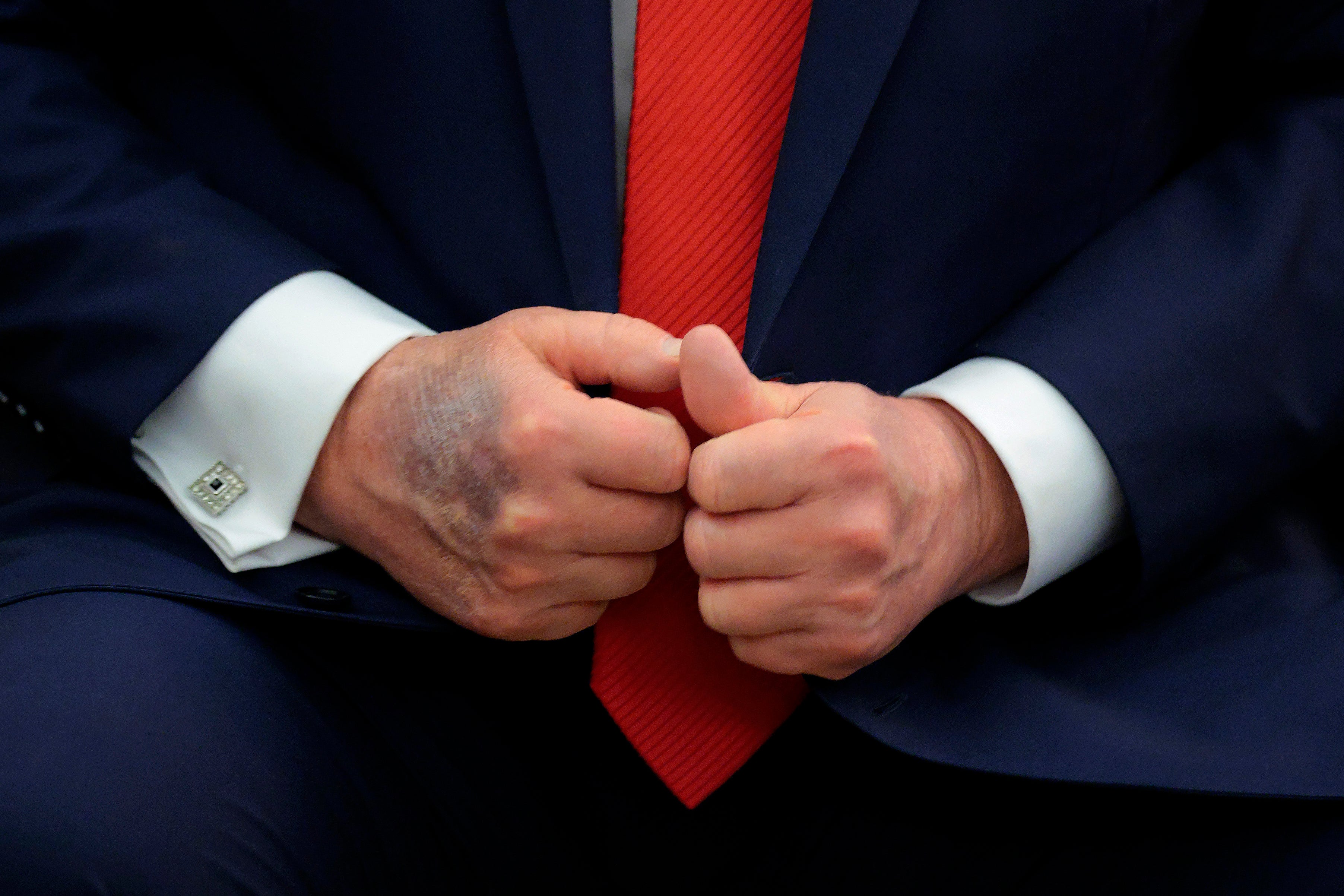 The report said Trump’s hand-bruising is consistent with ‘minor soft tissue irritation related to frequent handshaking’ while on aspirin therapy